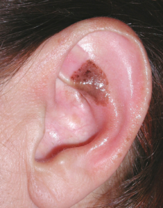 Lesione pigmantata orecchio di sinistra, con aspetto irregolare per asimmetria, bordi e colore: cheratosi seborroica benigna, Dermatologo Novara Crupi Agostino