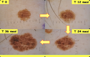 Evoluzione Neo non lineare, regola dell'ABCDE, dermatologo Novara, dottor Crupi Agostino