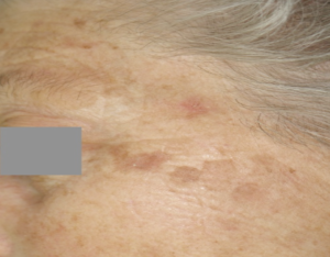 Cheratosi Attinica Donna
